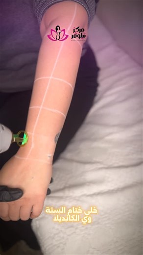 ‎مجمع نيلوڤر الطبي‎ on Instagram‎: "عروض الليزر بجهاز الكانديلا الثلجي الاصلي فول بدي 100 الف ميني بدي 80 الف ساق كامله 40 الف نصف ساق 25 الف يد كامله 40 الف نصف يد 25 الف وجه 20 الف بكيني 20 الف اندرام 20 الف وجه + رقبه 30 الف وجه + بكيني 40 الف وجه + اندرام 40 الف بكيني + اندرام 40 الف تحديد وجنات 15 الف تحديد لحيه كامل 15 الف ادفع جلستين مقدماً الثالثة مجاناً⁨ نيلوڤر تعني وردة… وأنتِ سيدتي ملكة الورود 🌷 العنوان/ بغداد _ زيونة _ الشارع الخدمي _ بين تقاطع الربيعي وتقاطع ملعب الشعب _ مقابل قاعة