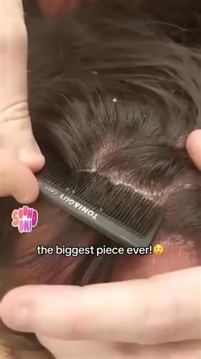 TheWatsons on Instagram: "The relief when you finally get the flakes out... nothing feels better. #ScalpRelief #DandruffCare #PsoriasisRelief #ScalpCleaning #SatisfyingVideo #ASMRHair #FlakyScalp #HairHealing #ScalpTreatment #HairCareRoutine #ItchyScalp #BeforeAndAfter #SatisfyingHair #HealingJourney #HairTok #RealScalpCare #SelfCareMoment #HairTransformation #CleansingVideo"