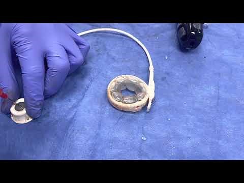 Lapband removal and how it works