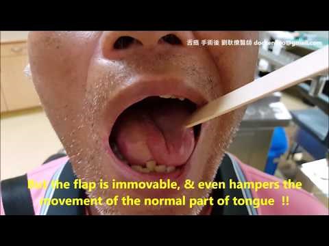 舌癌切除後的皮瓣重建，並無助舌頭功能的恢復 tongue cancer surgery