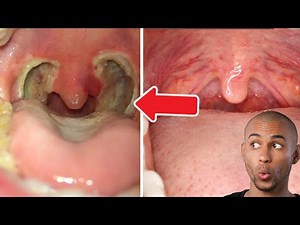 Tonsil Stone | Tonsillectomy