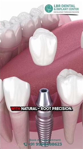 The Ultimate Solution for Missing Teeth - Why Dental Implants are the Game Changer | LBR Dental