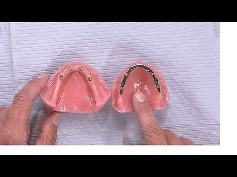 Case of the week: Placing a Removable Lower Denture Attached to Implants