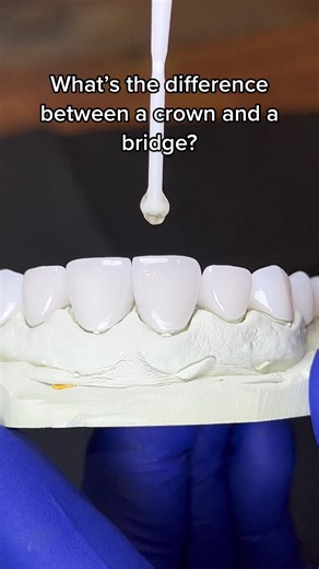 Dental Crown vs. Dental Bridge: Main Differences Explained
