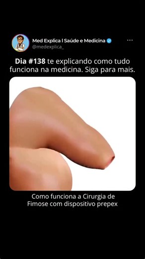 Medicina l Saúde l Curiosidades on Instagram: "APERTE EM SEGUIR 🩺🫀⬆️⬆️⬆️ A cirurgia de fimose com o método PrePex é uma alternativa moderna e menos invasiva à cirurgia tradicional. O procedimento utiliza um dispositivo plástico que é colocado ao redor do prepúcio, interrompendo a circulação sanguínea da pele excedente. Com isso, essa pele perde a vitalidade e é removida após alguns dias, sem cortes e sem pontos. O método é rápido, feito geralmente com anestesia local e não exige internação. Du
