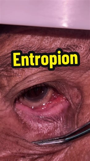 Understanding Entropion: Causes and Effects