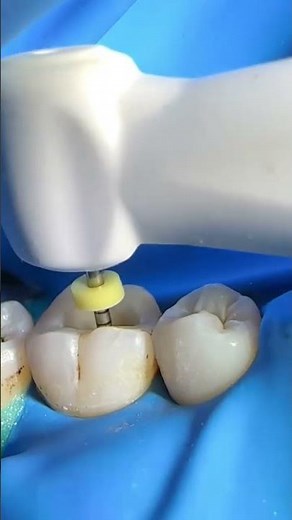 Pulpitis treatment, root canal treatment, root canal cleaning,root canal widening,Endomator,ProTaper