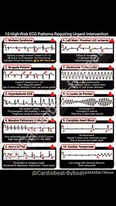 10 High-Risk ECG Patterns Requiring Urgent Intervention 1. Wellens – LAD critical stenosis 2. Brugada – VF risk 3. Hyperkalemia – Sine-wave evolution 4. Massive PE – S1Q3T3, RBBB 5. STEMI – Contiguous ST↑ 6. LM/prox LAD – ST↑aVR, diffuse ST↓ 7. VT – Treat as VT unless proven otherwise 8. TdP – Polymorphic VT long QT 9. 3° HB – AV dissociation, escape rhythm 10. Tamponade – Low voltage ± alternans Each pattern correlates with a time-sensitive clinical pathway. 📈 Review the diagnostic criteria ab