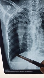 Collapse Lung Due to Cancer | Cancer Care by Dr.Salam