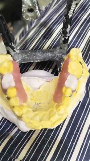 2 Unit Acrylic Removable Partial Denture Ready For Flasking 😁😁😁#rpddentalprocedure#partialdenture