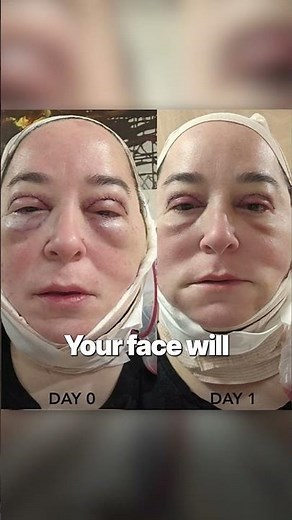 The First 48 Hours After A Facelift