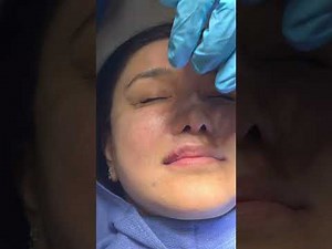 Lip Filler injection. Painless with nerve block. Restylane or Juvederm 202-621-8675