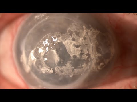 Tratamiento de la queratopatía en banda