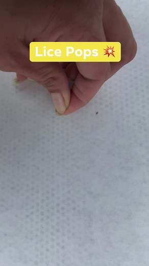 Lice popping #lice #liceasmr #reels #fyp | LRS - Lice Removal Service