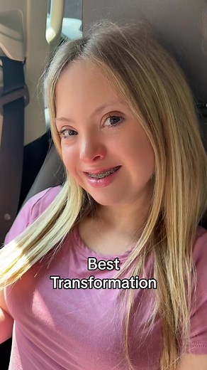Best Transformation! Braces came off today after 20 months and Kayla made a video to celebrate! If you are in DE go to Greeley Nista Orthodontics - they are AMAZING! #braces #bracesoff #orthodontist #orthodontics #bracestransformation #bracestok #timeforcandy #downsyndrome #sindromededown #trisomy21 #downsyndromeawareness #downsyndromeadvocate