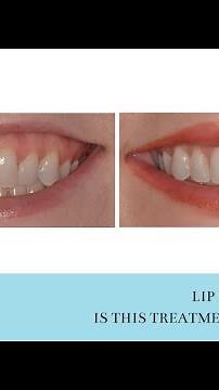 Lip Repositioning - Is this treatment permanent?