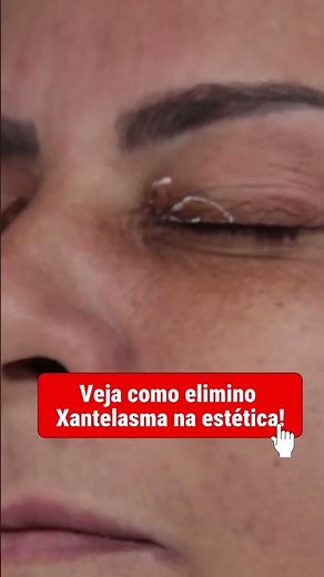 Como eu atuo em Xantelasma com Jato de plasma! #jatodeplasma #xantelasma #bellolharcursos