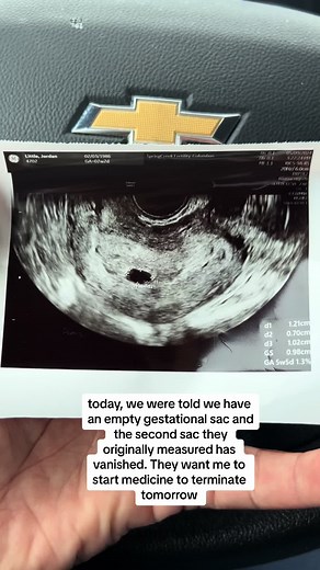 💔 #twinpregnancy #twins #miscarriage #7weekspregnant | pregnancy