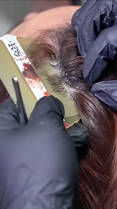 Heavy Flake Storm Deep Scalp Scratching & Ultimate Dandruff Relief 😳💆‍♀️ #HugeFlakes #DandruffASMR #DryScalpCare #ScalpScratching #SatisfyingASMR #ASMRScalp #244 | Scalp ASMR