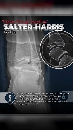 5 Weird Ways Bones Break While Growing