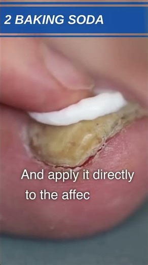 3 Natural Home Remedies for Toenail Fungus | DIY Foot Care Tips