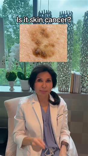 Would you catch this as melanoma? #skincheck #dermatology