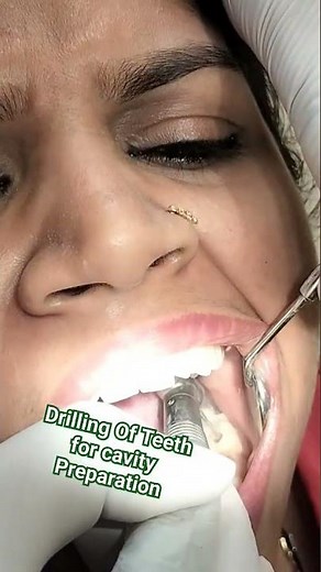 Drilling Of Teeth For Cavity Preparation