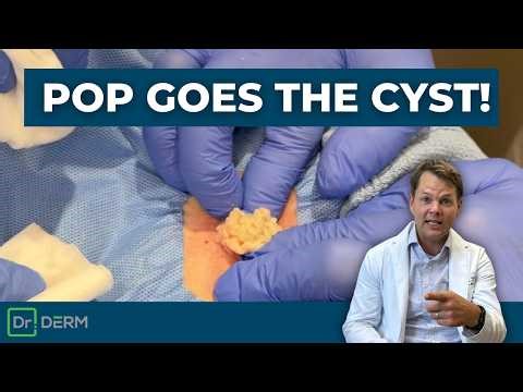 Pop Goes The Cyst! | Dr. Derm