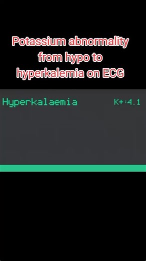 Understanding Potassium Abnormalities on ECG