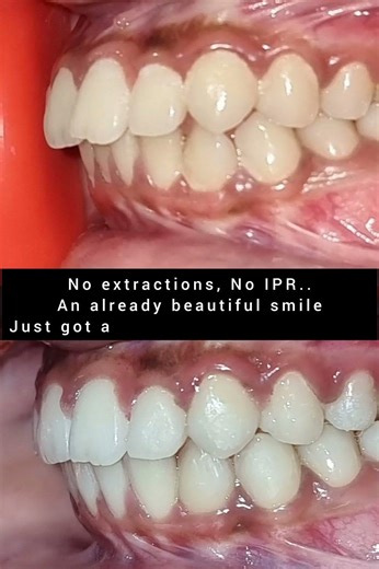Aligners before and after #braces #orthodonticaligners #smiledesign #clearaligners #transformation