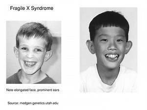 Fragile X Syndrome - SlideServe