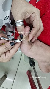 300K views · 1.1K reactions | Masaya na si client at satisfied pa dahil naalis lahat ng dryskin ito kasi talaga ang dinayo nila #fypシ゚viralシfypシ゚viralシalシ #postviralシ #fbreels #vedioviral #dryskin #FacebookPage #ContentMonetization #allaroundnanay | All Around Nanay | Facebook