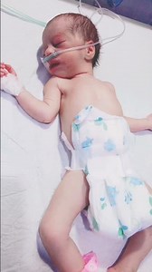 critical condition baby in NICU