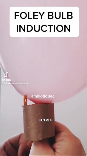 Foley Bulb Induction Explained: Process and Benefits