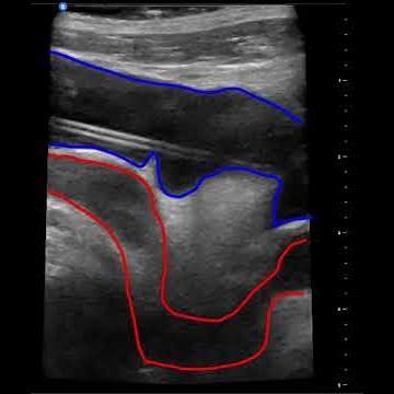 Difficult PICC insertion (Engorged Axillary Vein)