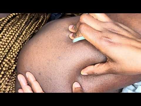 This Back Nitpicking will relax you instantly Pt2 😴