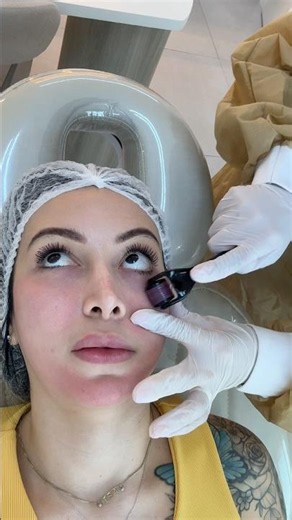 MICRONEEDLING TO STIMULATE COLLAGEN
