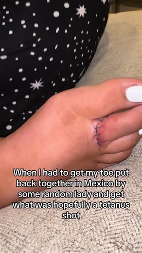Accidental Injury in Tulum: A Nurse's Experience