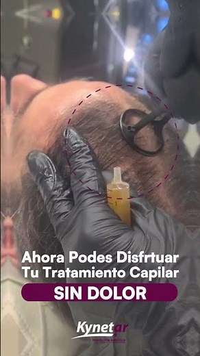 Nueva Tecnología tratamientos capilares