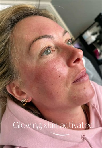 Skin boosters don’t change your face… they bring your skin back to life. Hydrated. Glowing. Healthy from within.✨ #CapCut