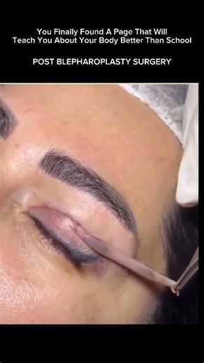 EXPLAINING OUR BODY | POST BLEPHAROPLASTY RECOVERY – WHAT TO EXPECT ✨ After blepharoplasty (eyelid surgery), the healing process is gradual and essential for... | Instagram