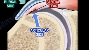 Internal Impingement of the Shoulder