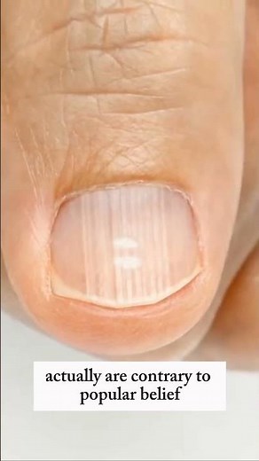 Vertical Ridges on Your Nails: What Do They Mean?