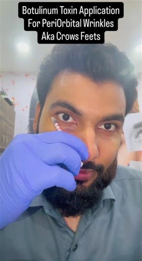 Botox for Crow’s Feet | Peri-Orbital Wrinkle Treatment | Live Injection Technique by Facial Surgeon