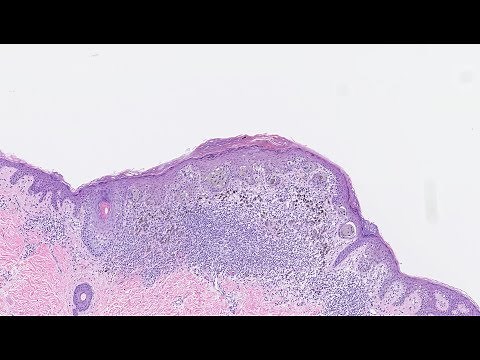 Study examines accuracy of melanoma biopsy findings