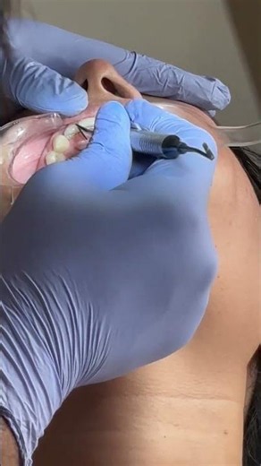 🚨Braces ya Invisalign ke Baad Retainer Nahi Lagaya? Daant Phir Tedhe Ho Sakte Hain! | Patna Dentist