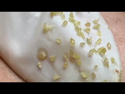 Great with big blackhead extraction (356) | Loan Nguyen