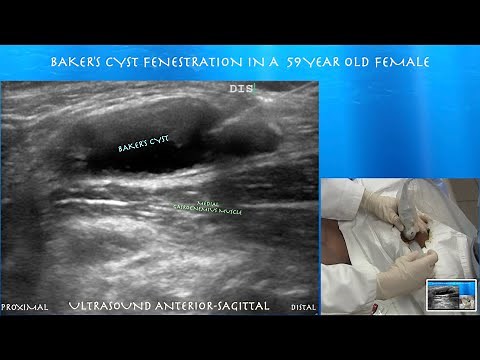 Ultrasound Guided Popliteal Cyst Aspiration & Fenestration