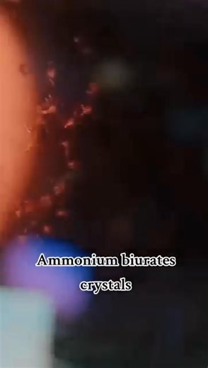 Urine slide 😲😲🔬❤️ | Lab life