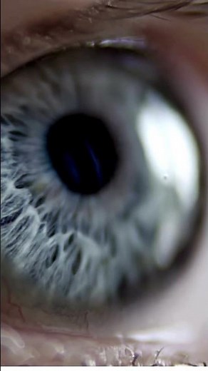 "Meet Pupula Duplex: The Eye Condition with Two Irises! 👁️👁️"